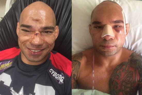 Фото: "Киборг" Сантос до и после операции